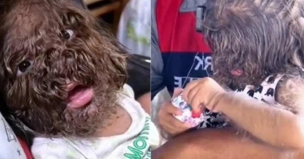 Minoxidil: 11 crianças nascem com “síndrome do lobisomem” após pais usarem loção para combater calvície